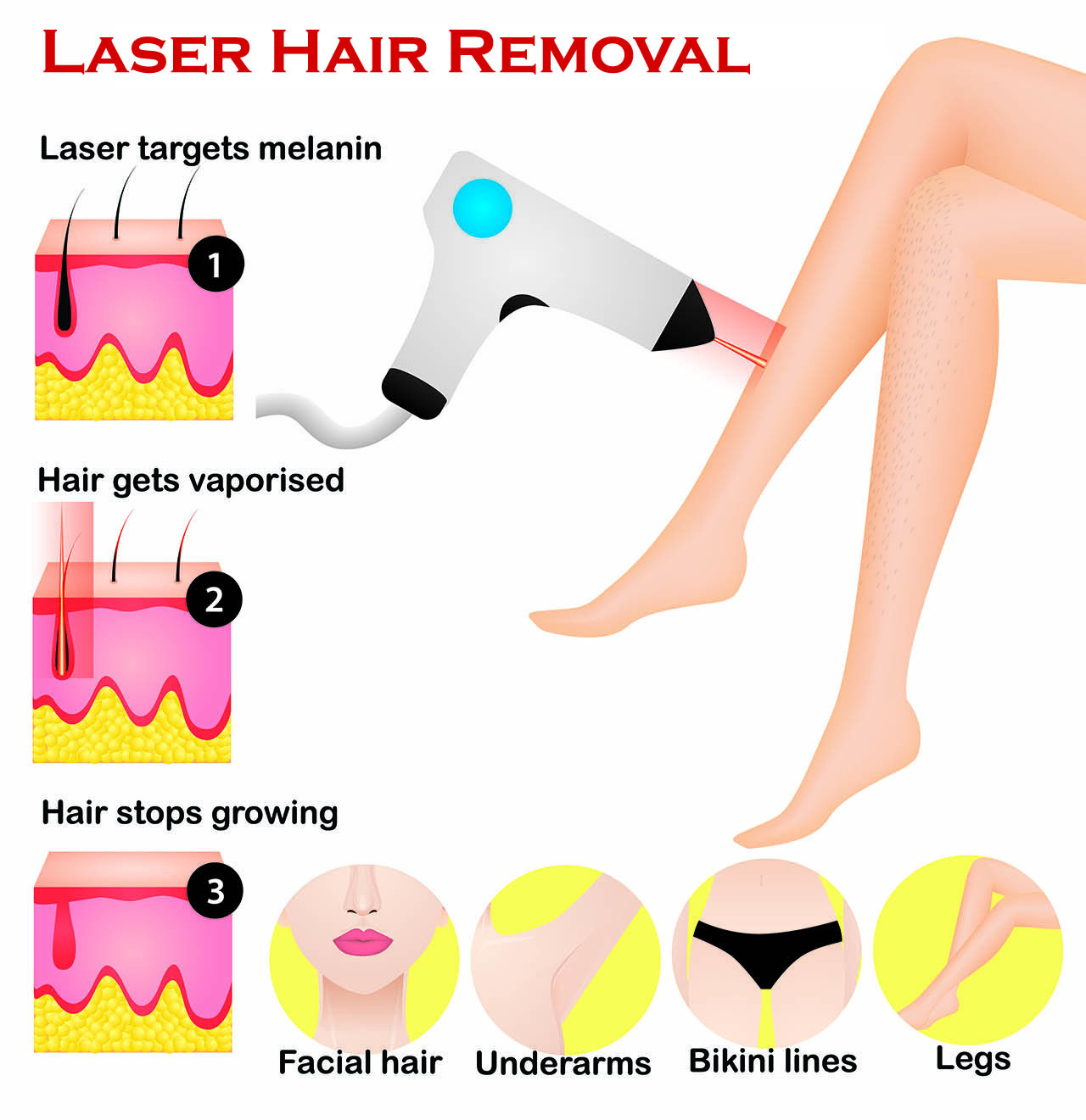 How laser hair removal works