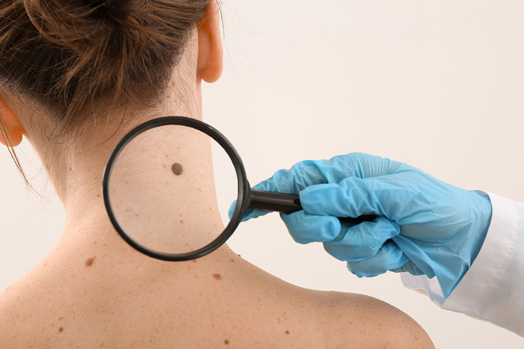 Mole removal - is it right for you?