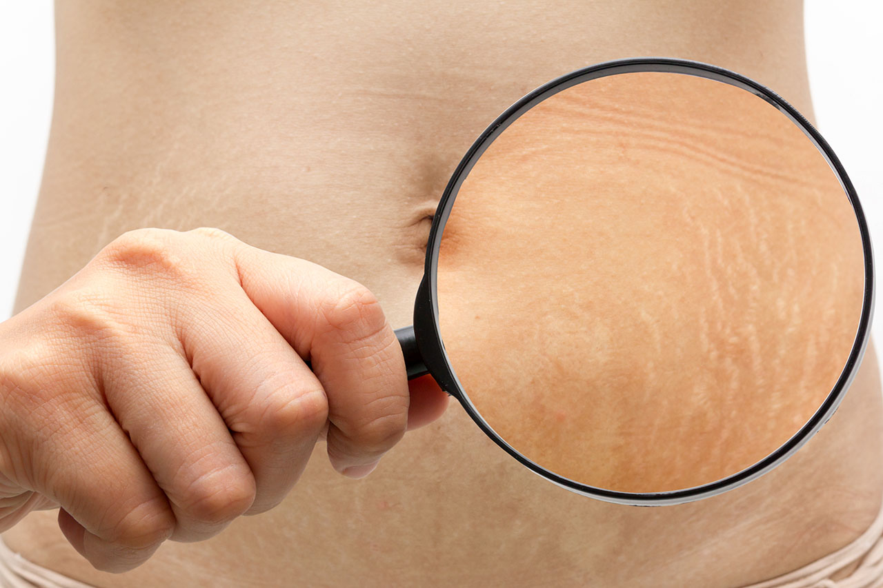 Can you remove stretch mark?