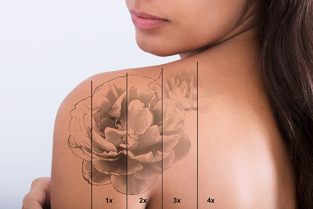 Laser Tattoo Removal Everything You Need to Know  AuthorityTattoo