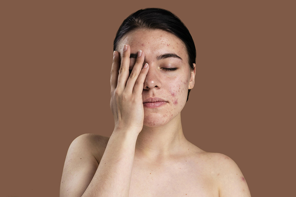 Acne scars - How do you treat them?