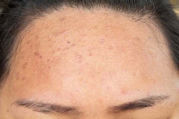 acne-scars-how-do-you-treat-them-arium-clinic-medical-aesthetics