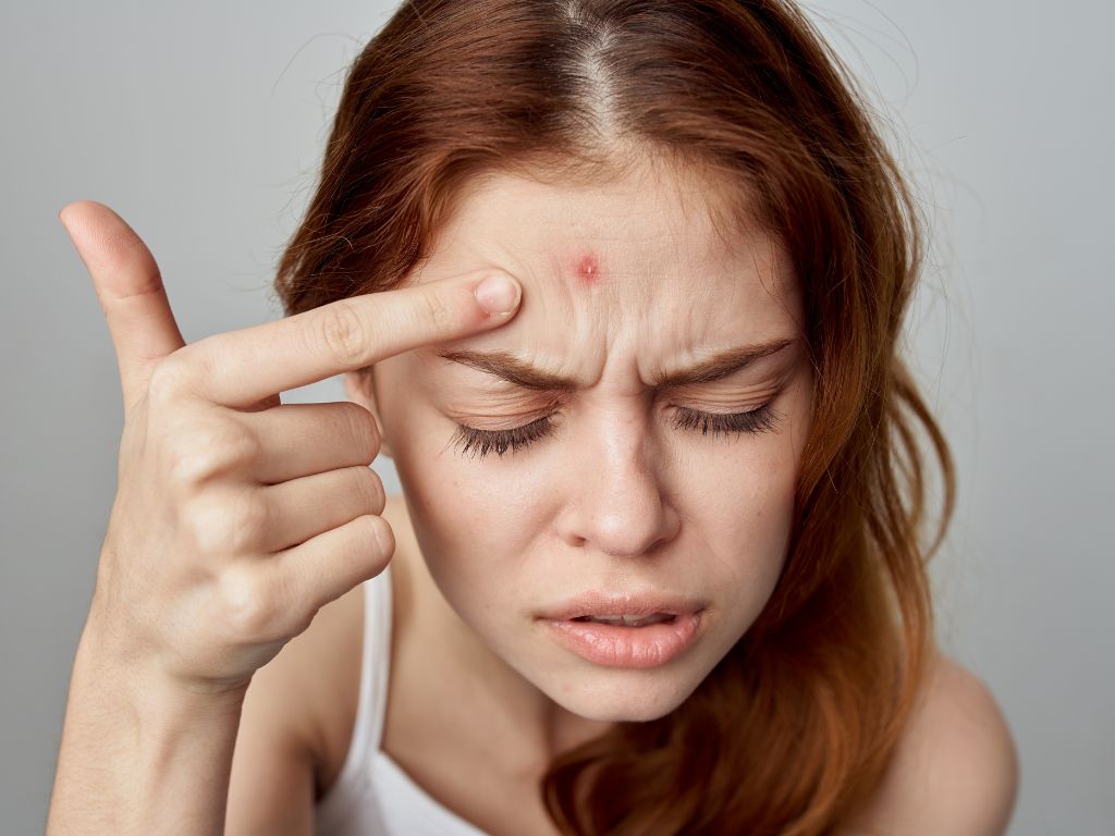 acne scar treatments in Singapore